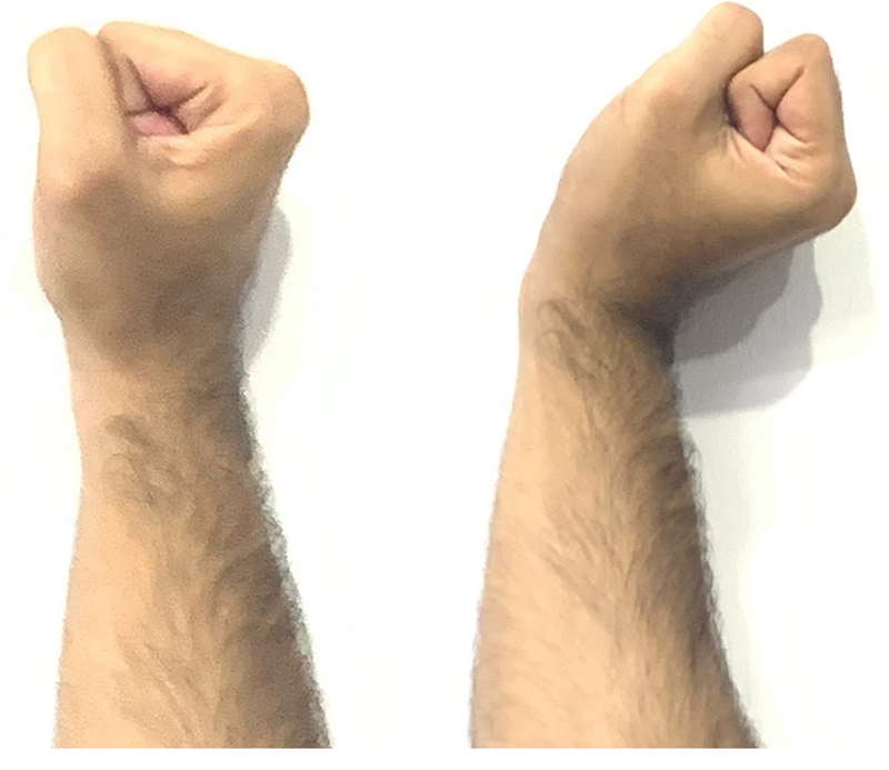Wrist Position: Neutral (Left) and Extended (Right).