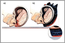 Vista seccionada de la cabeza y
cerebro mientras sufre una ca&iacute;da
frontal.
