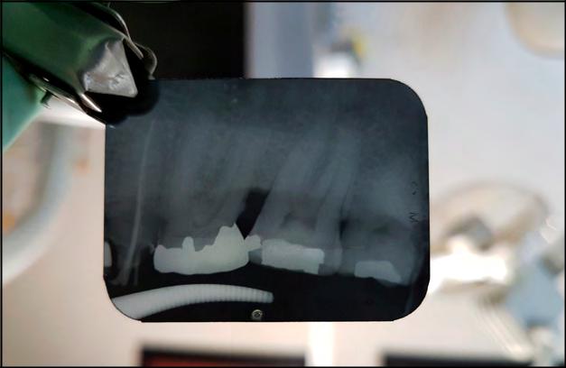 Fotografía
de una radiografía dental periapical con claridad
y nitidez. Se controlaron los factores que pueden ser negativos al paciente por
la radiación ionizante, que desprende el aparato de rayos X.