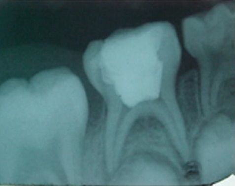 Se estudia el extracto de orégano como alternativa al formocresol en pulpotomías infantiles.