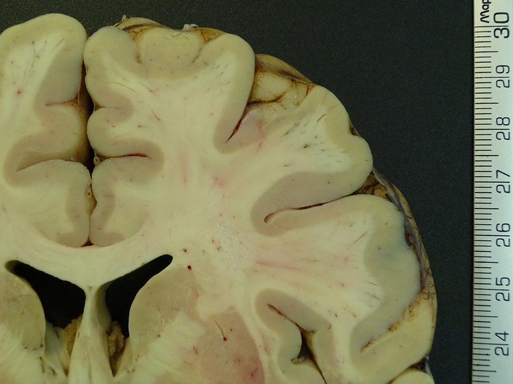 Corte coronal del cerebro de una persona con obesidad. Se representa la medicin del grosor de la corteza cerebral.