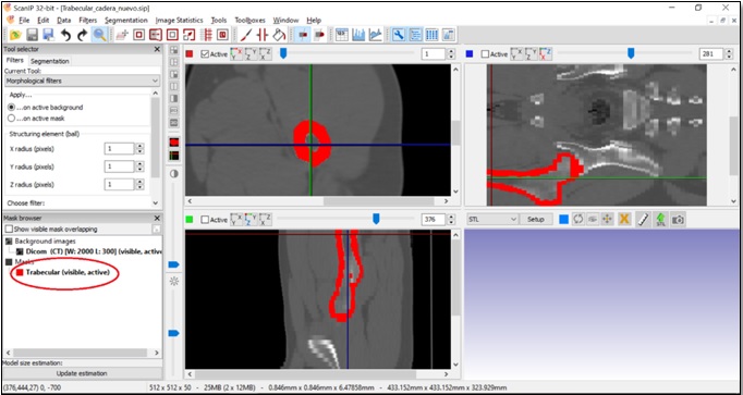 M�scaras para generar el modelo de hueso.