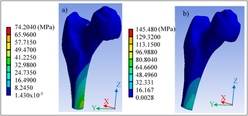 Tensi�n de Von Mises en hueso trabecular a) sin porosidad, b) con porosidad.