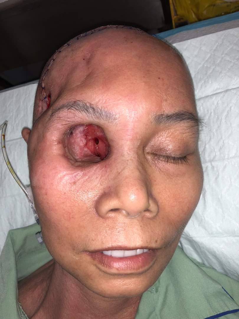 Intraorbital wall defect post exenteration of the right orbit exposing the right optic canal surrounded by granulation tissues.