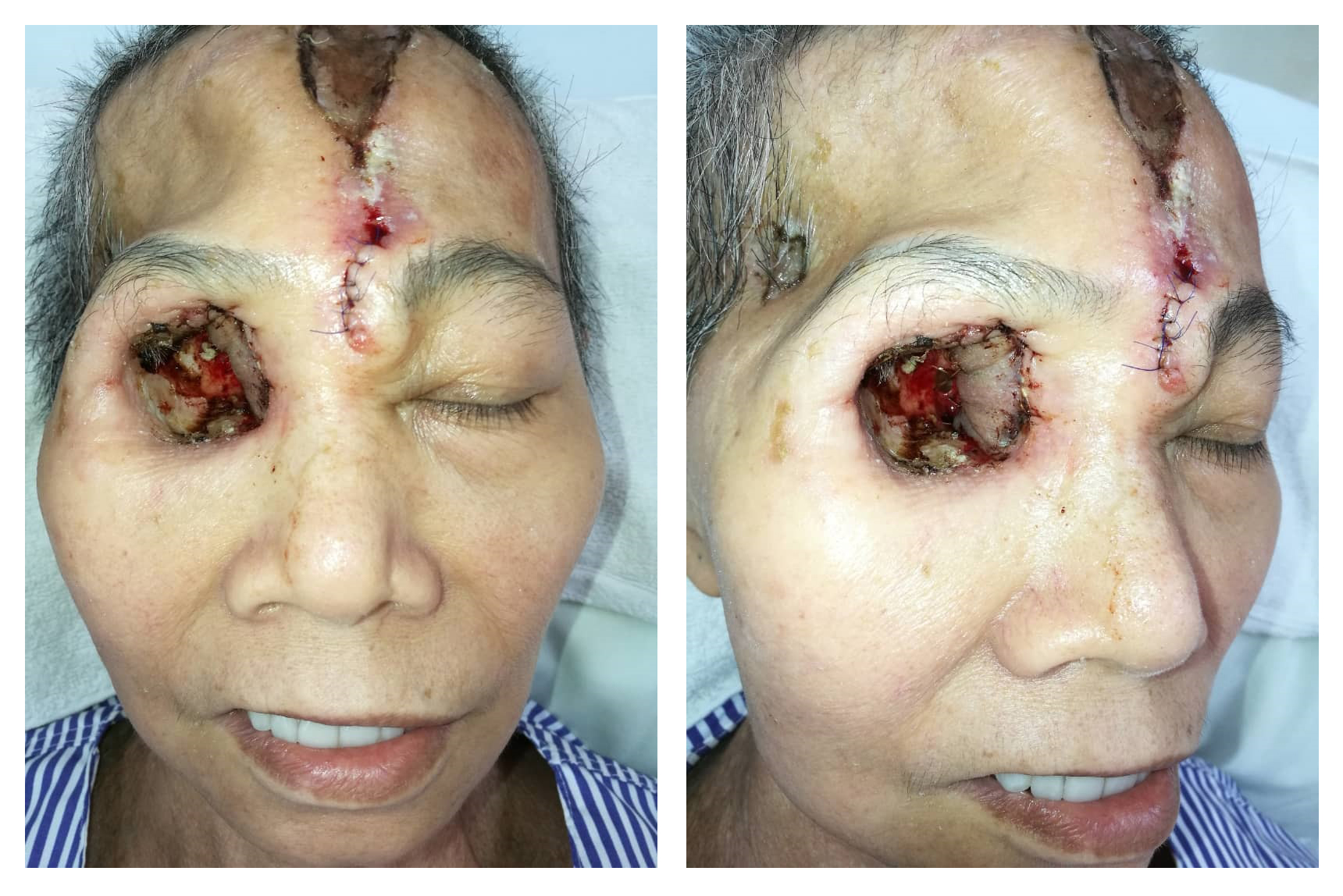 Final result after 3 weeks of flap delay and flap division & inset.