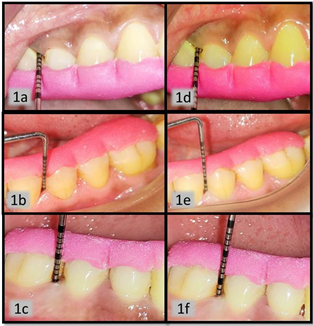 Figure 1a, b, c are baseline probing pocket depth clinical picture of group A, B, C respectively. The baseline evaluation was recorded in range 5-6mm of PPD. Figure 1d, e, f are postoperative PPD recorded 3 month post-operatively for group A, B and C, respectively, which was found to be in range of 3-4 mm.
