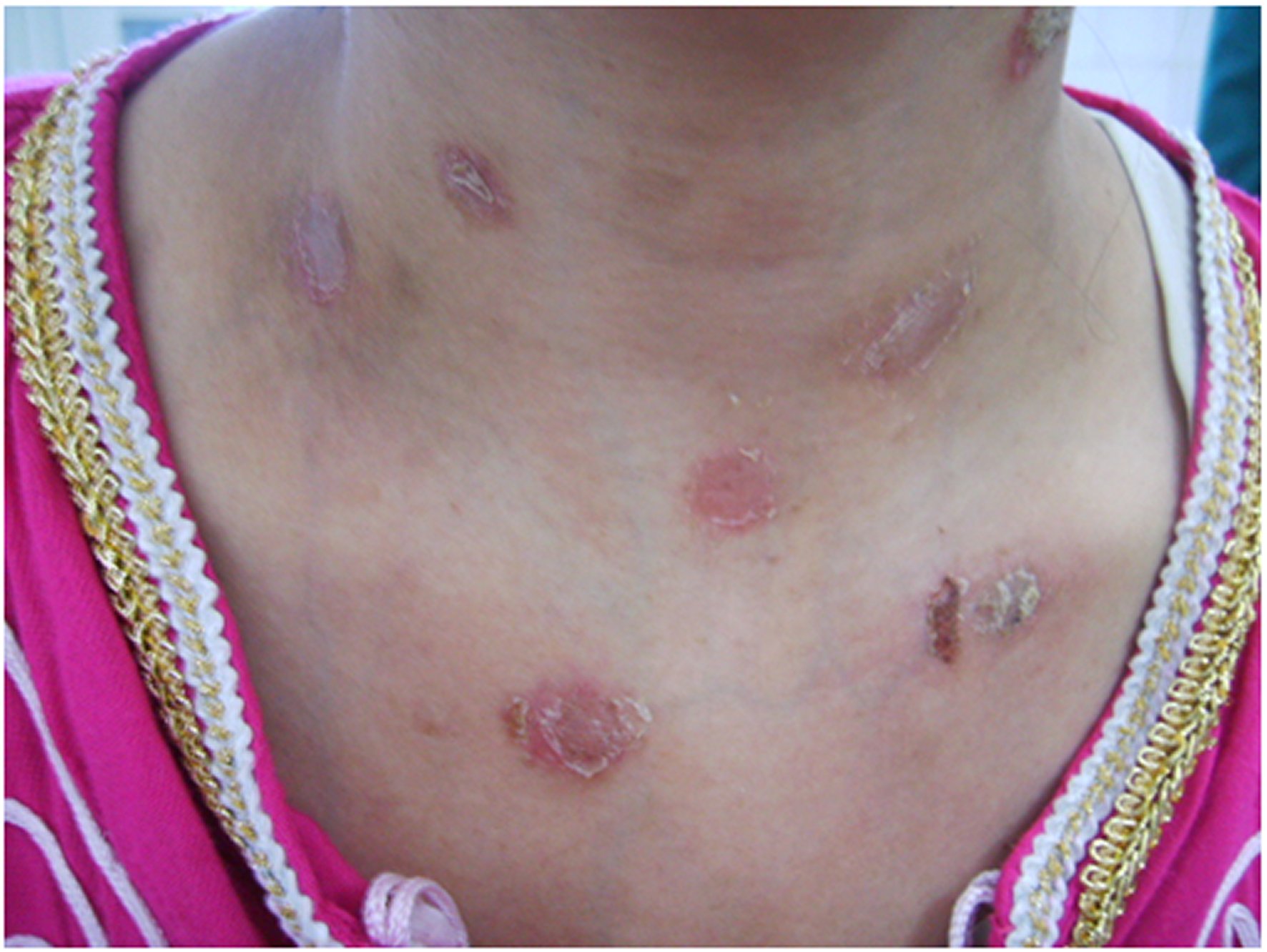 Multiple and ruptured bullous lesions of the neckline and neck.