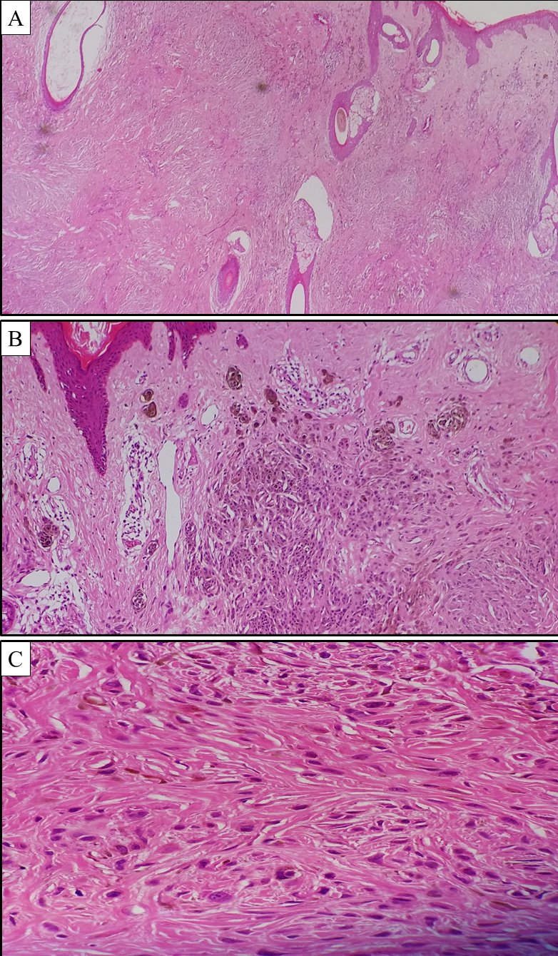 Photo micrograph of the lesion.