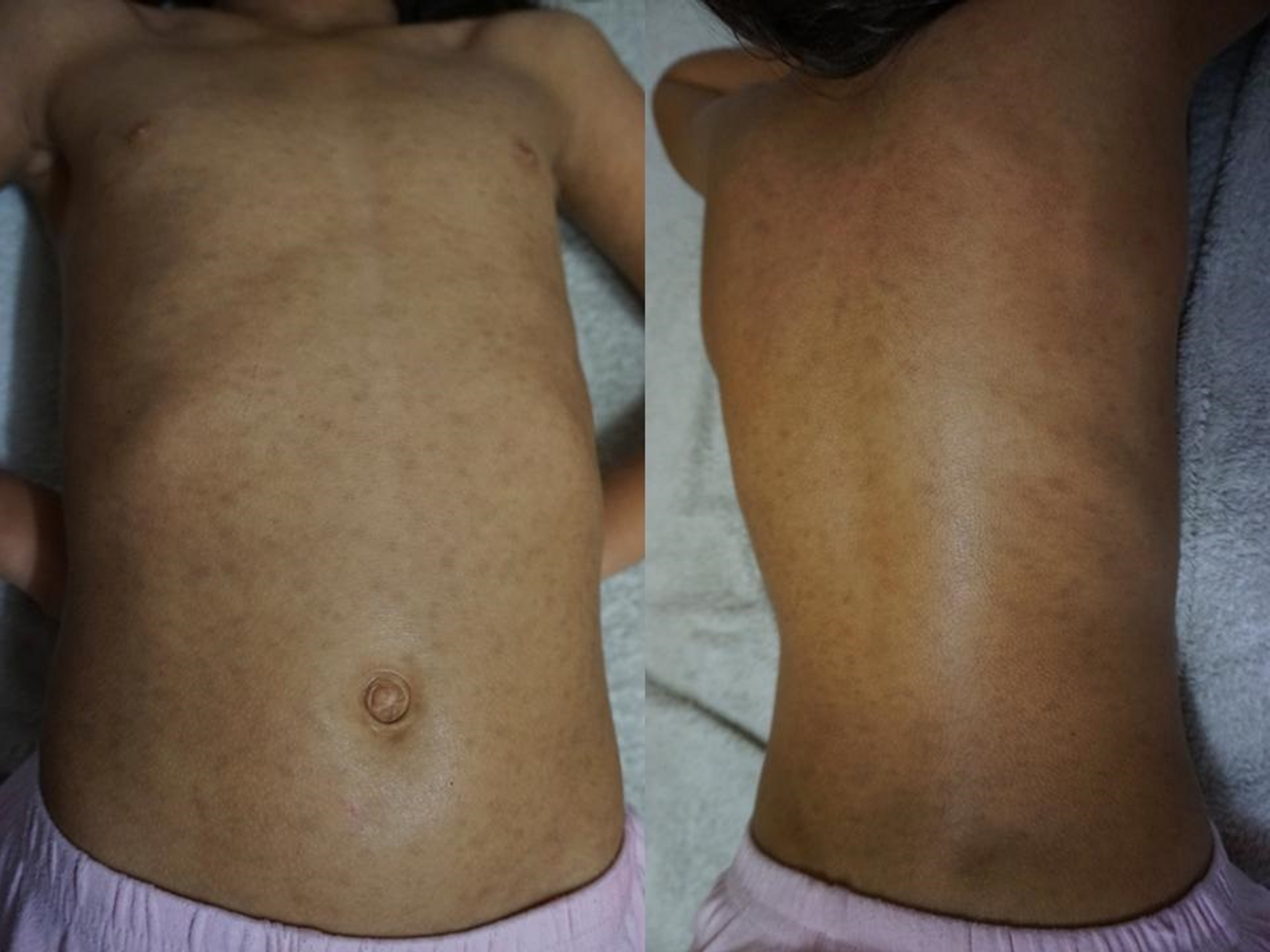 Multiple discrete, dark-brown, round-to-oval, small (< 1 cm in diameter), well-defined, nonconfluent macules over the front and back of the patients trunk.