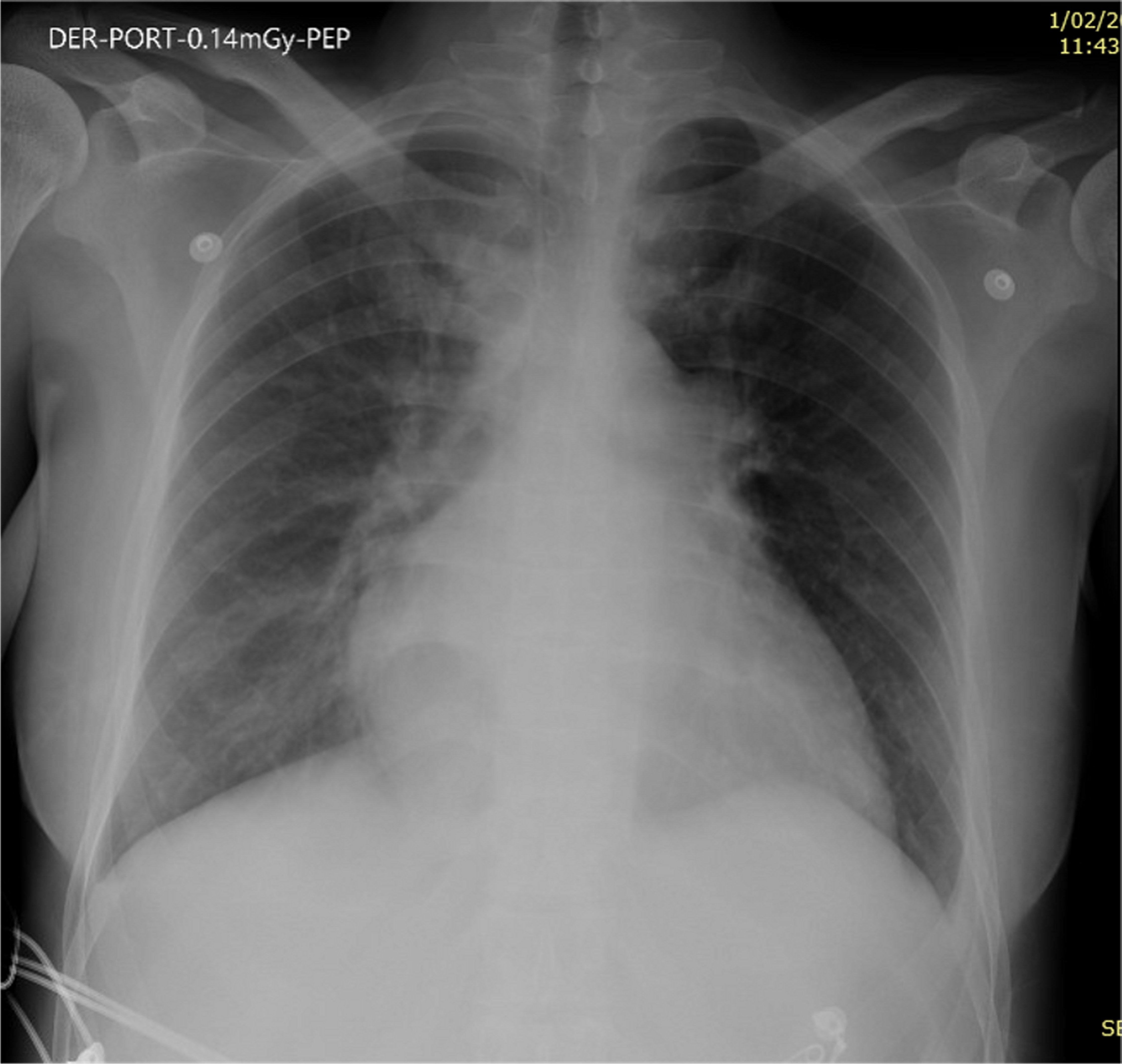 Chest X-ray shows enlargement of the cardiac silhouette and bilateral interstitial infiltrates.