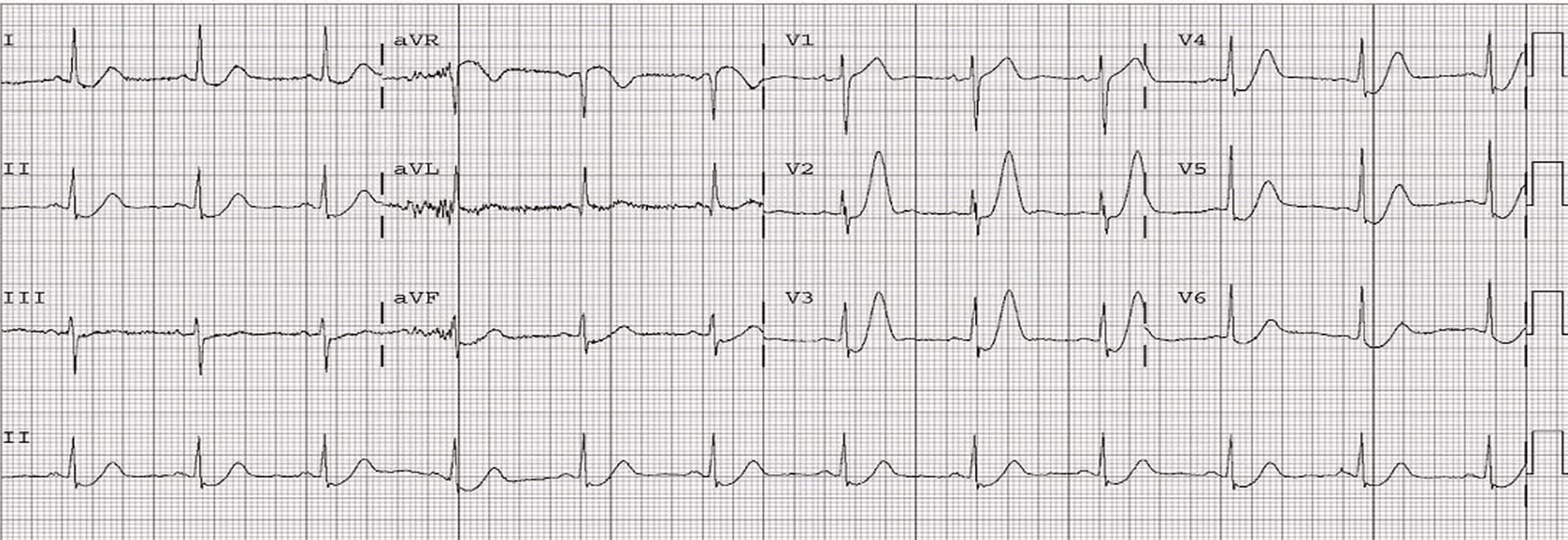 12-lead ECG showed upsloping ST segment depression with prominent and symmetrical T waves in the precordial leads and reciprocal ST segment elevation in aVR.