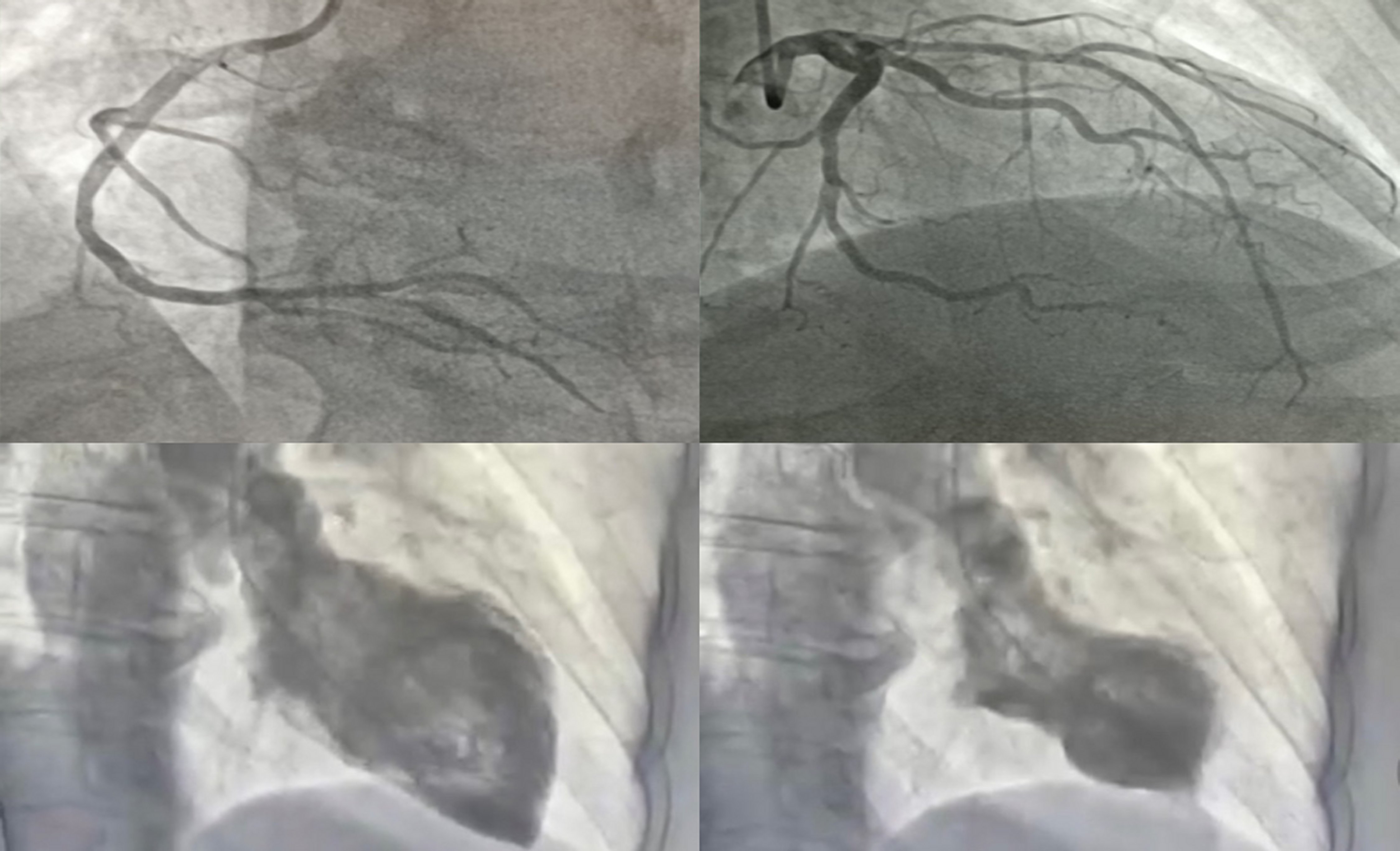 Coronary angiography without significant lesions and ventriculography image of apical ballooning.