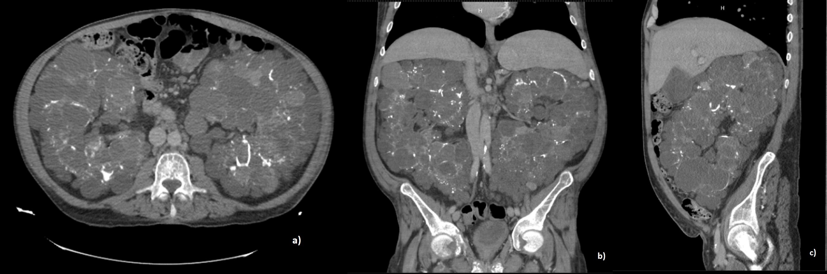 Abdominopelvic contrast - enhanced CT. A) Axial plane. B) Coronal plane. C) Sagittal plane. Both kidneys are enlarged, with loss of the usual morphology and lobulated borders. Multiple rounded images with well-defined hypodense borders are observed, with average attenuation values ranging from -7 to 36 HU. Some of these images have thick and calcified walls, as well as thin septa. There are other hyperdense lesions with attenuation values of up to 60 HU. None of the lesions show enhancement with contrast media. No evidence of pelvicalyceal or ureteral dilatation.