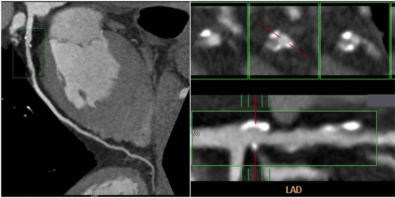 A coronary plaque with moderate lumen stenosis seen on CCTA. Multiple calcified & thick soft plaques were seen in the proximal LAD with moderate stenosis ( 50-60%; length = 7 mm & 5 mm).