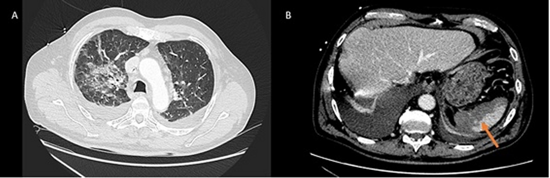 Computed tomography. Bilateral pulmonary infiltrates (Image A) Image compatible with splenic infarction (Image B).