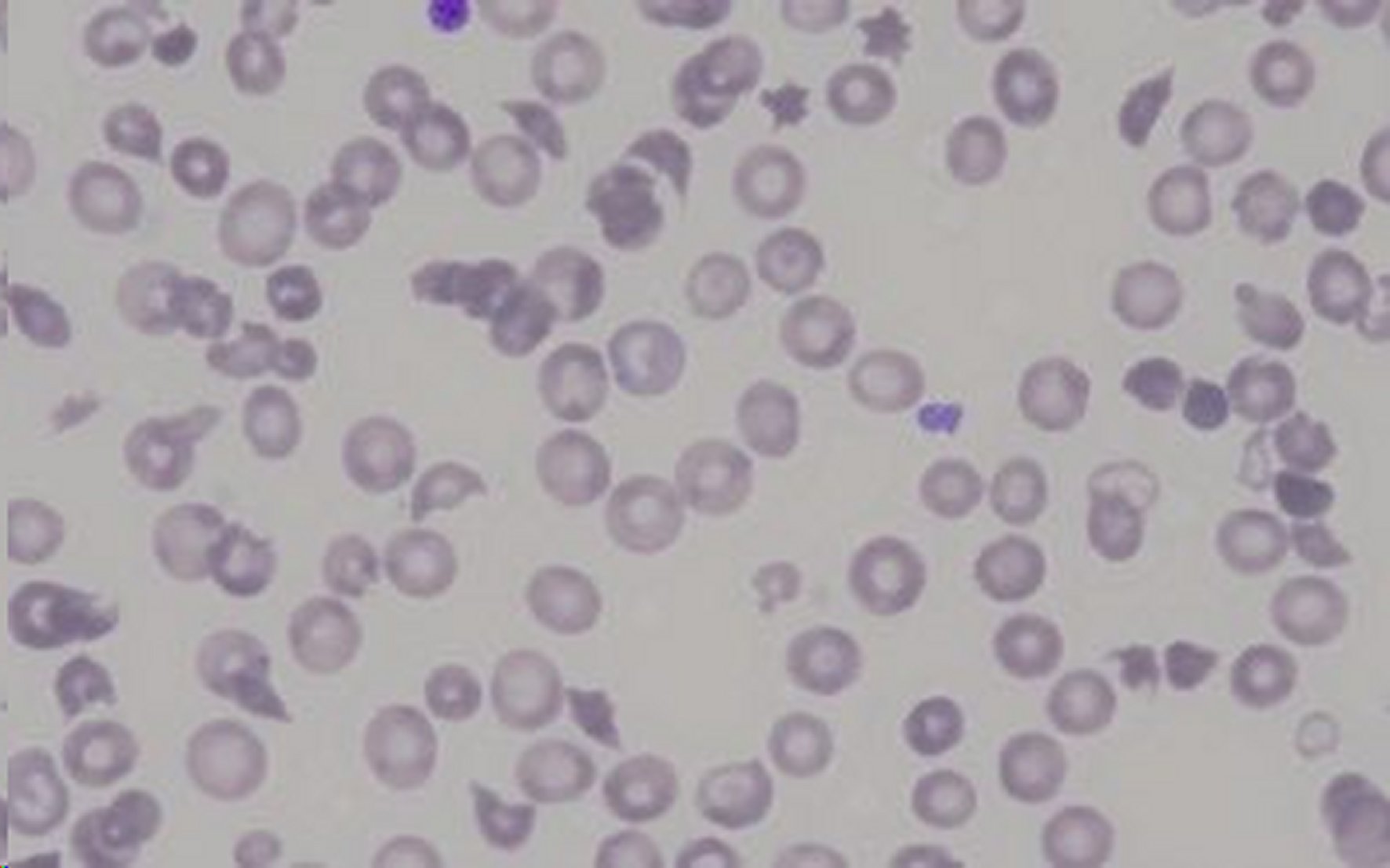 Blood smear with the presence of schistocytes.