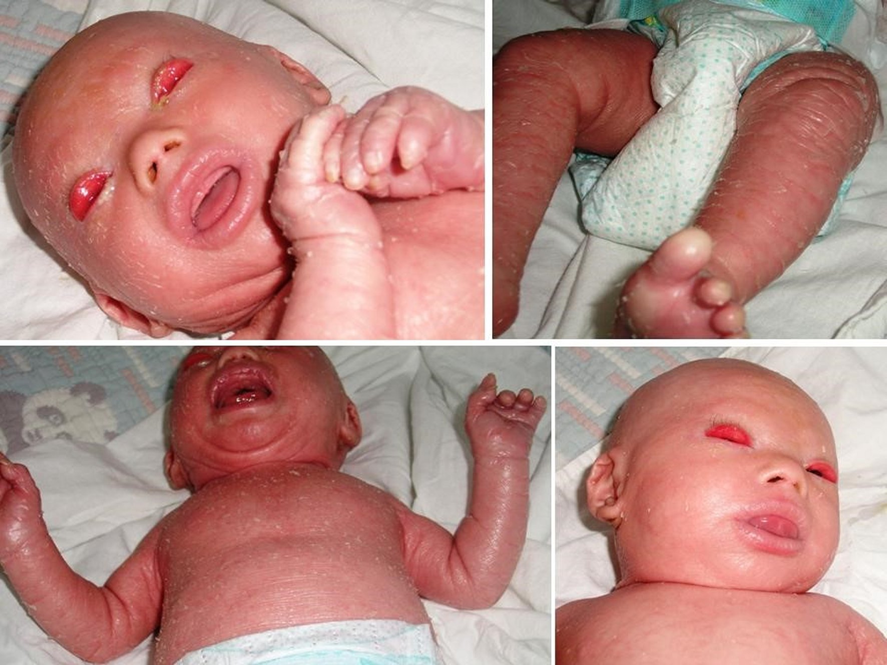 A 3-month-old male affected by Harlequin Ichthyosis was treated from birth with oral retinoid, dermatological and ophthalmological care, and physiotherapy. He presents shiny hyperkeratotic, cracked, peeling, and slightly fissured skin, bilateral ectropion of the upper eyelids, supraciliary madarosis, eclabium, hypoplastic and folded ears, hypoplasia of the nasal bones, and hypoplasia and contracture of the fingers of the hands.