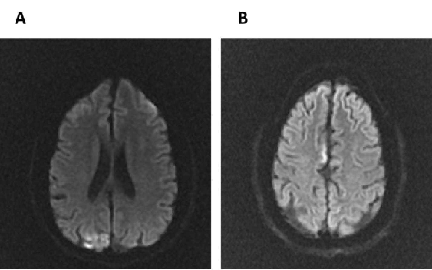  Brain MRI in adult patient diagnosticated with MELAS Syndrome. 24 years old woman with confirmed mA3243G mutation and classical MELAS syndrome.  Diffusion weighted brain MRI images show two SLE. A: right temporoparietal cortical hyperintensity corresponding to first SLE; B: the same patient, hospitalized two weeks after by another SLE, image shows cortical hyperintensity in the medial right frontal region. The previous lesion is not visible 
