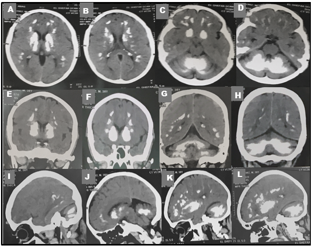 CT scan images from April 2023 revealing widespread bilateral hyperdense lesions (Calcifications) in the frontal and parietal lobes, periventricular white matter, basal ganglia, thalami, and cerebellar hemispheres. The calcifications are visible in axial (A-D), coronal (E-H) and sagittal (I-L) views, with no signs of mass effects.