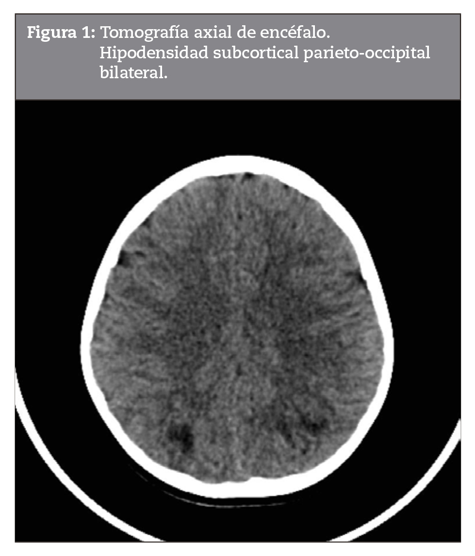Tomografa axial de encfalo. Hipodensidad subcortical parieto-occipital bilateral.