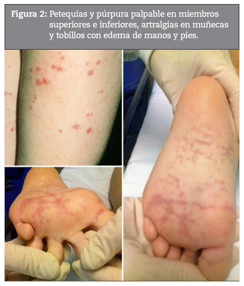 Petequias y prpura palpable en miembros superiores e inferiores, artralgias en muecas y tobillos con edema de manos y pies.