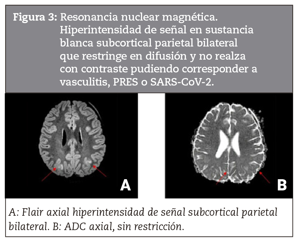Resonancia nuclear magntica. Hiperintensidad de seal en sustancia blanca subcortical parietal bilateral que restringe en difusin y no realza con contraste pudiendo corresponder a vasculitis, PRES o SARS-CoV-2.