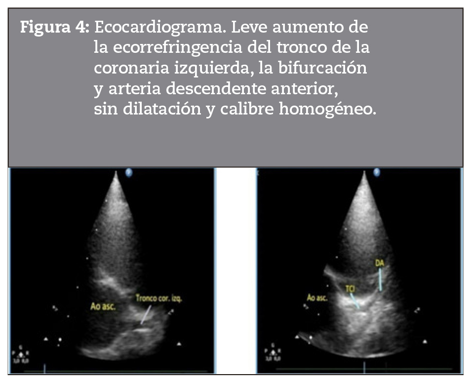 Ecocardiograma. Leve aumento de la ecorrefringencia del tronco de la coronaria izquierda, la bifurcacin y arteria descendente anterior, sin dilatacin y calibre homogneo.