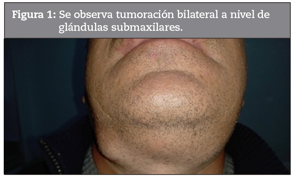 Se observa tumoracin bilateral a nivel de glndulas submaxilares.
