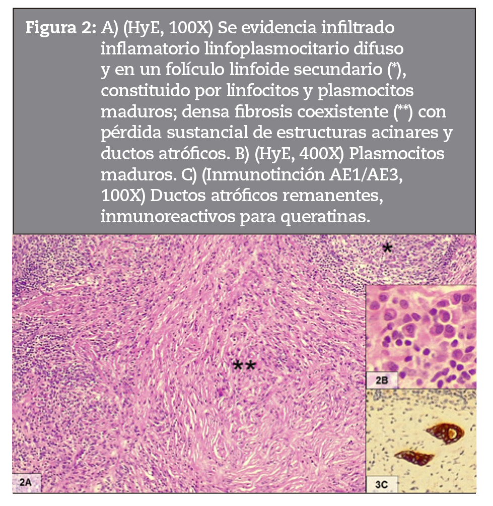 A) (HyE, 100X) Se evidencia infiltrado inflamatorio linfoplasmocitario difuso y en un folculo linfoide secundario (*), constituido por linfocitos y plasmocitos maduros; densa fibrosis coexistente (**) con prdida sustancial de estructuras acinares y ductos atrficos. B) (HyE, 400X) Plasmocitos maduros. C) (Inmunotincin AE1/AE3, 100X) Ductos atrficos remanentes, inmunoreactivos para queratinas.
