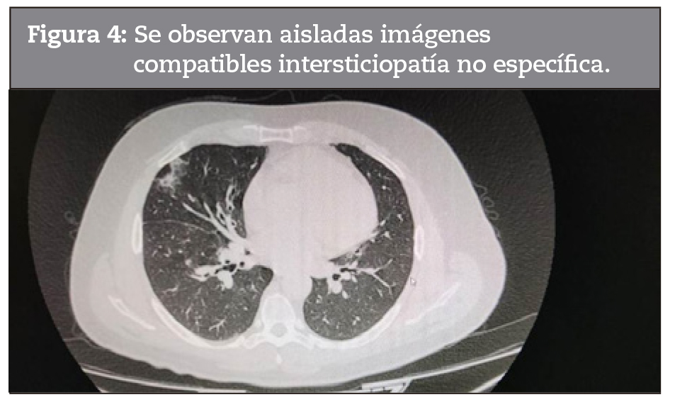 Se observan aisladas imgenes compatibles intersticiopatia no especfica.