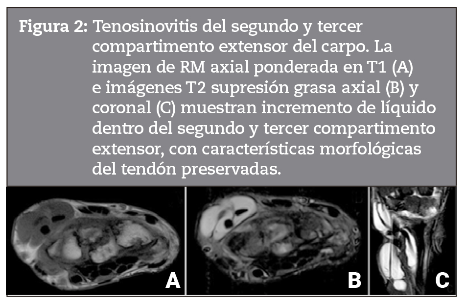 a 2: Tenosinovitis del segundo y tercer compartimento extensor del carpo. La imagen de RM axial ponderada en T1 (A) e imgenes T2 supresin grasa axial (B) y coronal (C) muestran incremento de lquido dentro del segundo y tercer compartimento extensor, con caractersticas morfolgicas del tendn preservadas.