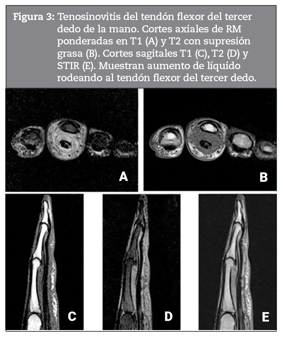 Tenosinovitis del tendn flexor del tercer dedo de la mano. Cortes axiales de RM ponderadas en T1 (A) y T2 con supresin grasa (B). Cortes sagitales T1 (C), T2 (D) y STIR (E). Muestran aumento de lquido rodeando al tendn flexor del tercer dedo. 