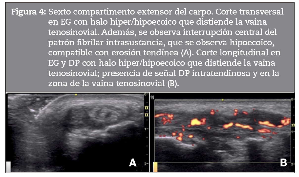 a 4: Sexto compartimento extensor del carpo. Corte transversal en EG con halo hiper/hipoecoico que distiende la vaina tenosinovial. Adems, se observa interrupcin central del patrn fibrilar intrasustancia, que se observa hipoecoico,compatible con erosin tendnea (A). Corte longitudinal enEG y DP con halo hiper/hipoecoico que distiende la vainatenosinovial; presencia de seal DP intratendinosa y en la zona de la vaina tenosinovial (B).
