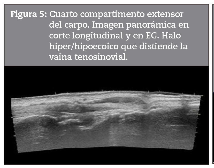 Cuarto compartimento extensor del carpo. Imagen panormica en corte longitudinal y en EG. Halo hiper/hipoecoico que distiende la vaina tenosinovial.