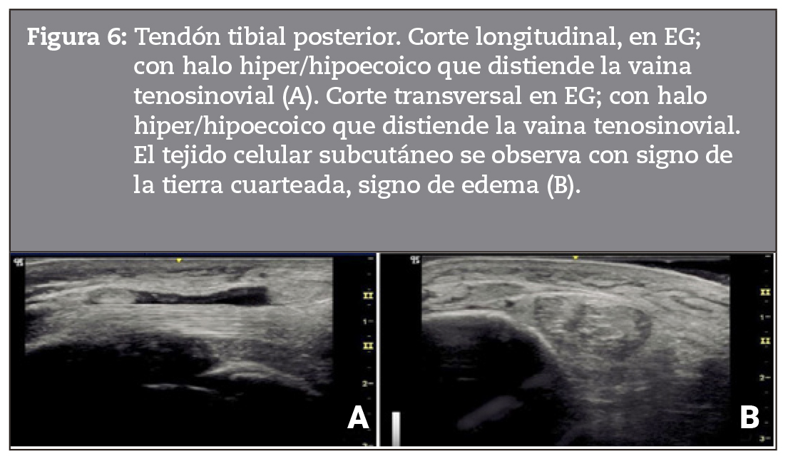 Tendn tibial posterior. Corte longitudinal, en EG; con halo hiper/hipoecoico que distiende la vaina tenosinovial (A). Corte transversal en EG; con halohiper/hipoecoico que distiende la vaina tenosinovial. El tejido celular subcutneo se observa con signo dela tierra cuarteada, signo de edema (B).
