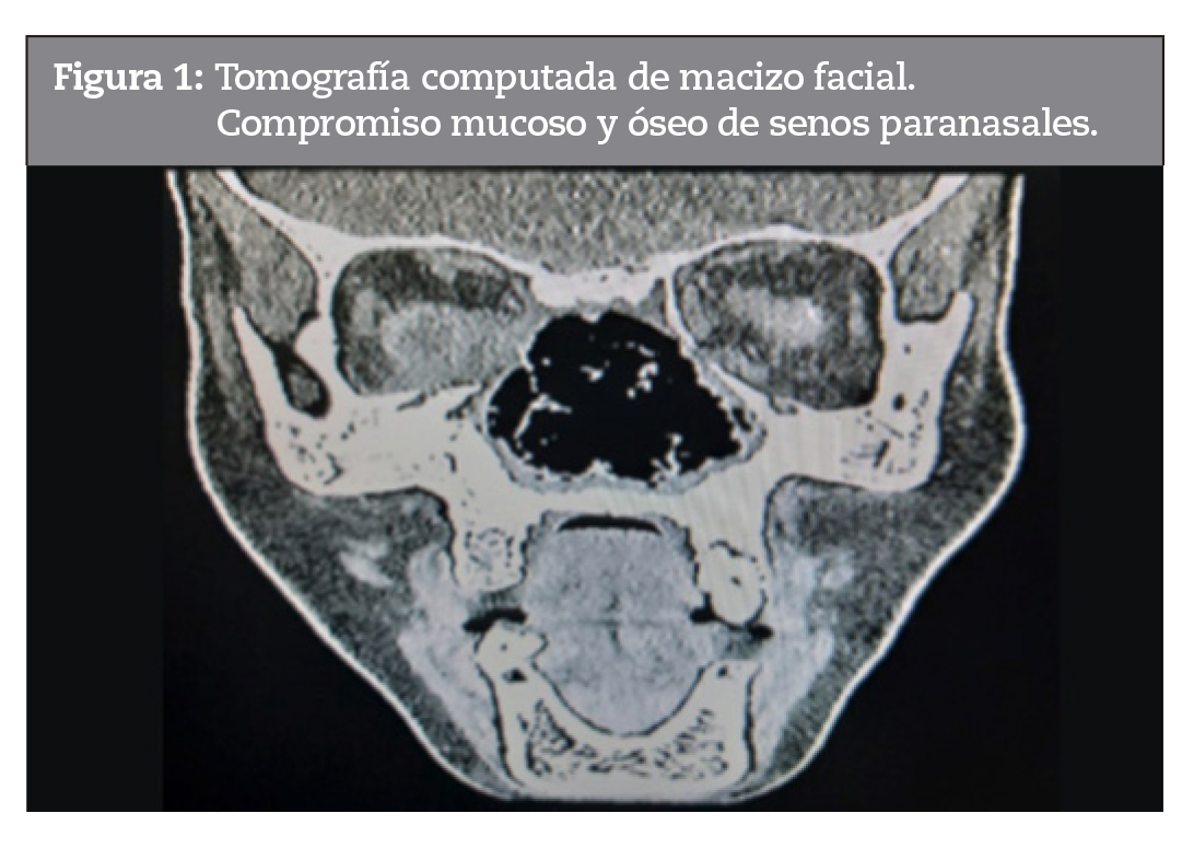 Tomografa computada de macizo facial.Compromiso mucoso y seo de senos paranasales.