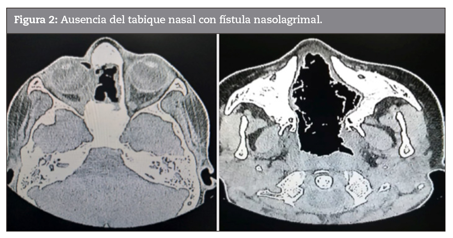 Ausencia del tabique nasal con fstula nasolagrimal.
