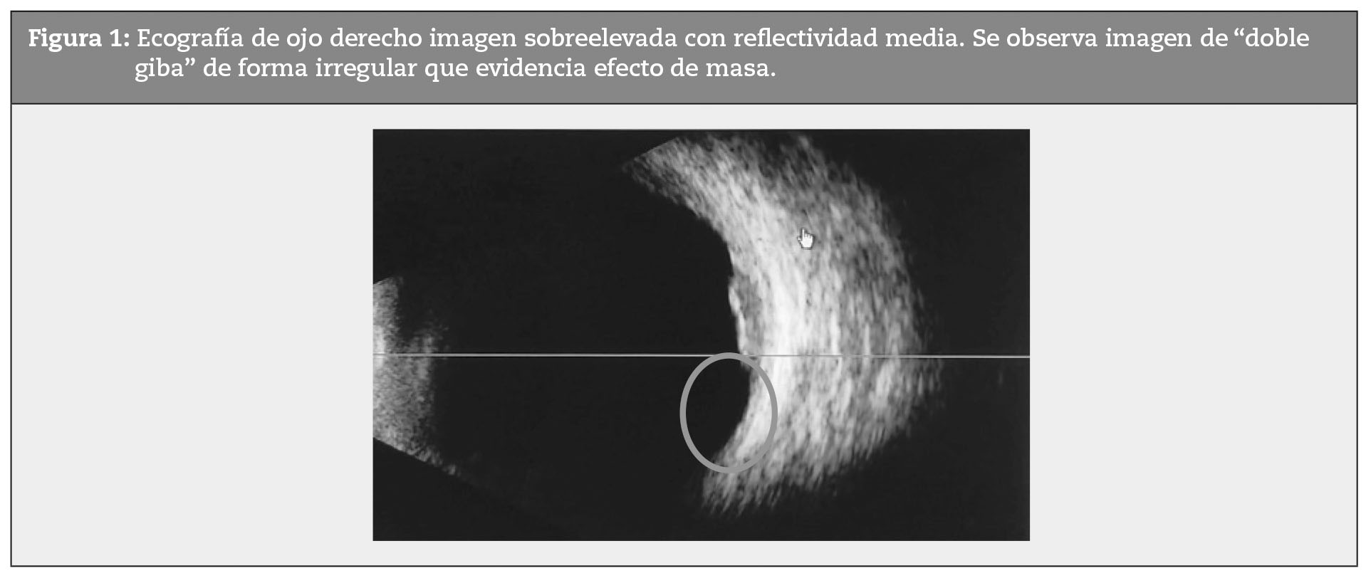 Ecografa de ojo derecho imagen sobreelevada con reflectividad media. Se observa imagen de “doble giba” de forma irregular que evidencia efecto de masa.