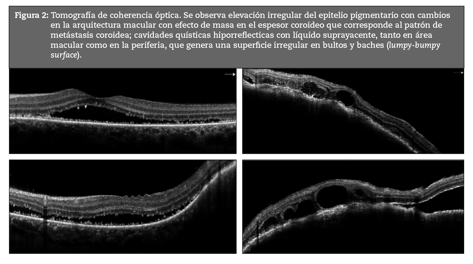 Tomografa de coherencia ptica. Se observa elevacin irregular del epitelio pigmentario con cambios en la arquitectura macular con efecto de masa en el espesor coroideo que corresponde al patrn de metstasis coroidea; cavidades qusticas hiporreflecticas con lquido suprayacente, tanto en rea macular como en la periferia, que genera una superficie irregular en bultos y baches (lumpy-bumpy surface).