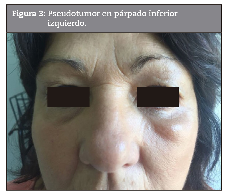 Pseudotumor en prpado inferior izquierdo.