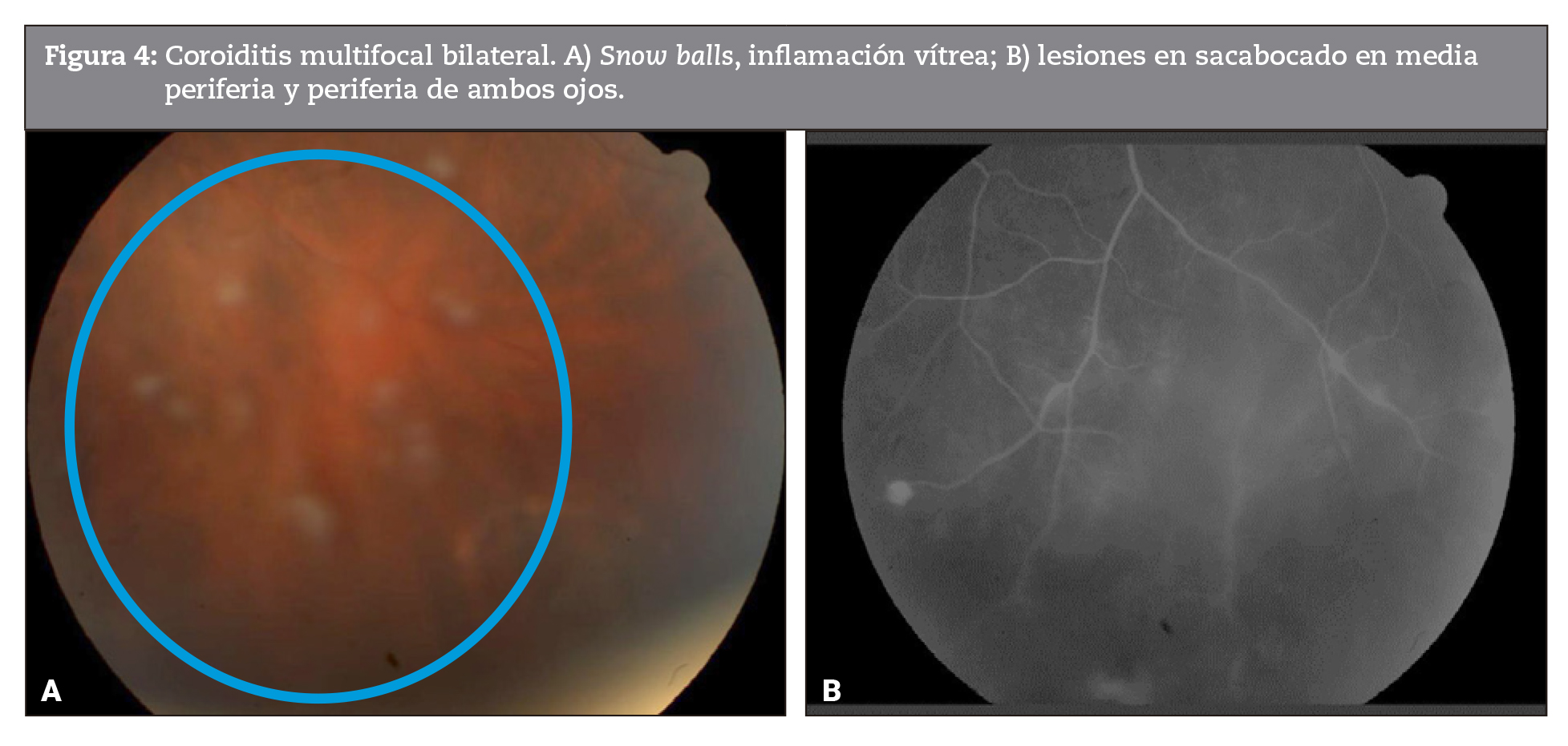 Coroiditis multifocal bilateral. A) Snow balls, inflamacin vtrea; B) lesiones en sacabocado en media periferia y periferia de ambos ojos. 