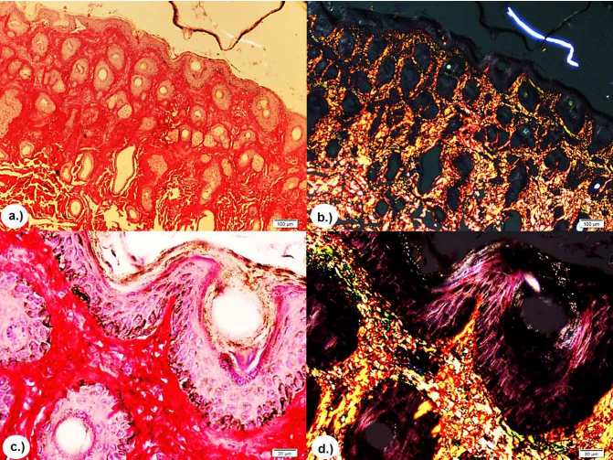 P-R/P stain without polarization and with polarization, respectively. Showing areas of reddish and yellowish-green birefringence indicating moderate presence of mature collagen type I (bright red in polarization) and type III (bright green-yellow in polarization). a.) and b.) 4X. c.) and d.) 10X.