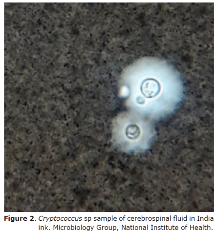 Figure 2.Cryptococcus sp
sample of cerebrospinal fluid in India ink. Microbiology Group, National
Institute of Health.