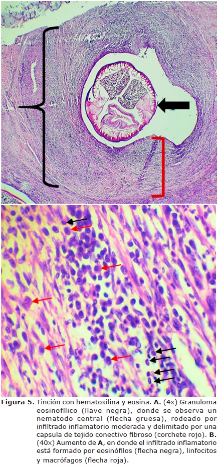 Figura 5. Tinci&oacute;n con hematoxilina y eosina. A.
(4x) Granuloma eosinof&iacute;lico (llave negra), donde se observa un nematodo central
(flecha gruesa), rodeado por infiltrado inflamatorio moderada y delimitado por
una capsula de tejido conectivo fibroso (corchete rojo). B. (40x)
Aumento de A, en donde el infiltrado inflamatorio est&aacute; formado por
eosin&oacute;filos (flecha negra), linfocitos y macr&oacute;fagos (flecha roja).