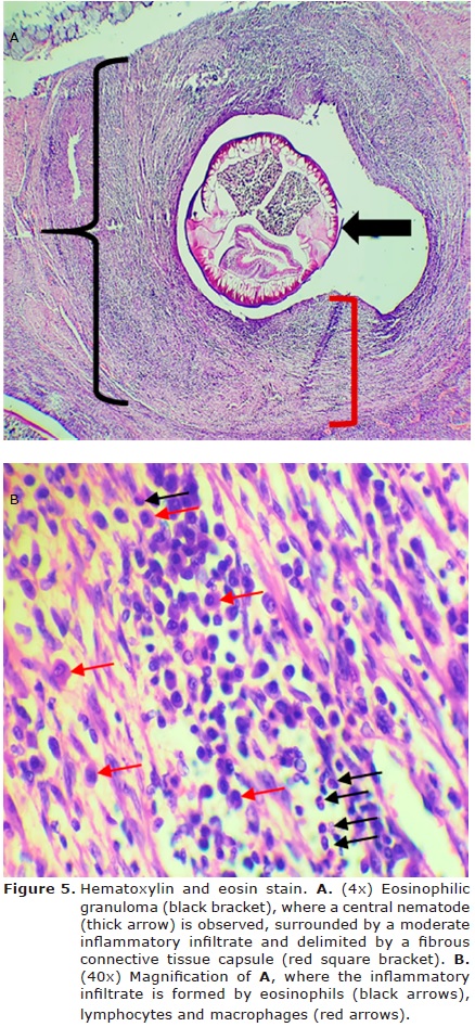 Figure 5. Hematoxylin
and eosin stain. A. (4x) Eosinophilic granuloma (black bracket), where a
central nematode (thick arrow) is observed, surrounded by a moderate inflammatory
infiltrate and delimited by a fibrous connective tissue capsule (red square
bracket). B. (40x) Magnification of A, where the inflammatory
infiltrate is formed by eosinophils (black arrows), lymphocytes and macrophages
(red arrows).