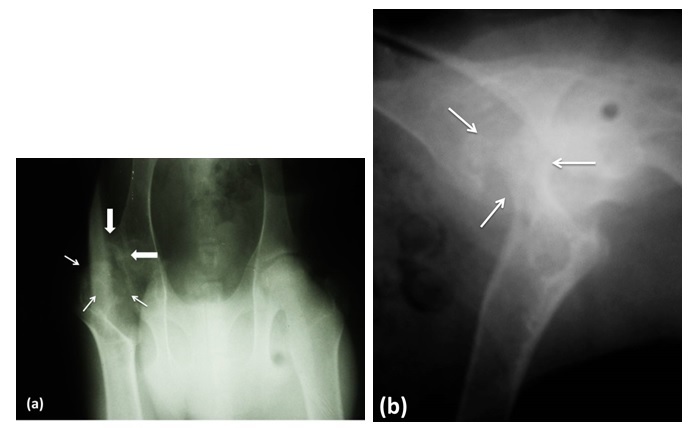  Hip x-ray in ventrodorsal
incidence (a) and lateral mid incidence (b) of a 7-month-old male alpine goat.
Right coxal articulation: irregularity and porous
aspect of the femoral head with areas of decreased density in the epiphysis,
compatible with focal bony lysis (thin arrows). The cranial - lateral area of
the acetabulum has osteophytes (thick arrows). Flattening and
irregularity of the articular surface of the head of the femur that causes
subluxation of the joint.