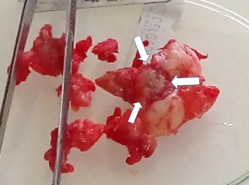 Surgical
piece after the femoral head and neck exeresis.
The tissue is multifragmented with irregular fibrous
tissue, a region of collapsed and necrotic articular cartilage (white arrows),
as well as subchondral cracks (black arrows) is evident in the femoral head.