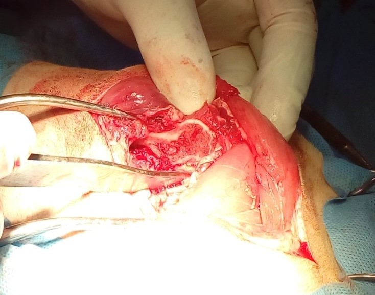  The incision line is
verified after the excision of the right femoral head and neck.
