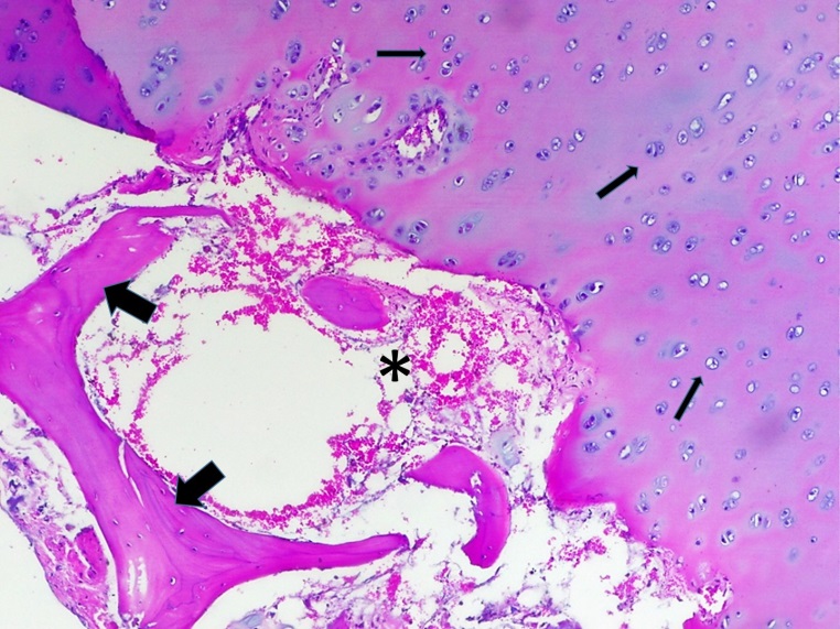 Section of necrotic bone,
the articular cartilage is thickened and abnormal chondrocyte dispositions are
observed (thin arrows). Area of subchondral bone necrosis, there are empty
trabecular bone gaps containing necrotic osteocytes (thick arrows). The hematopoietic
tissues show depression and you can see atrophic adipose tissue (asterisk)
(Hematoxylin and eosin, 20x).