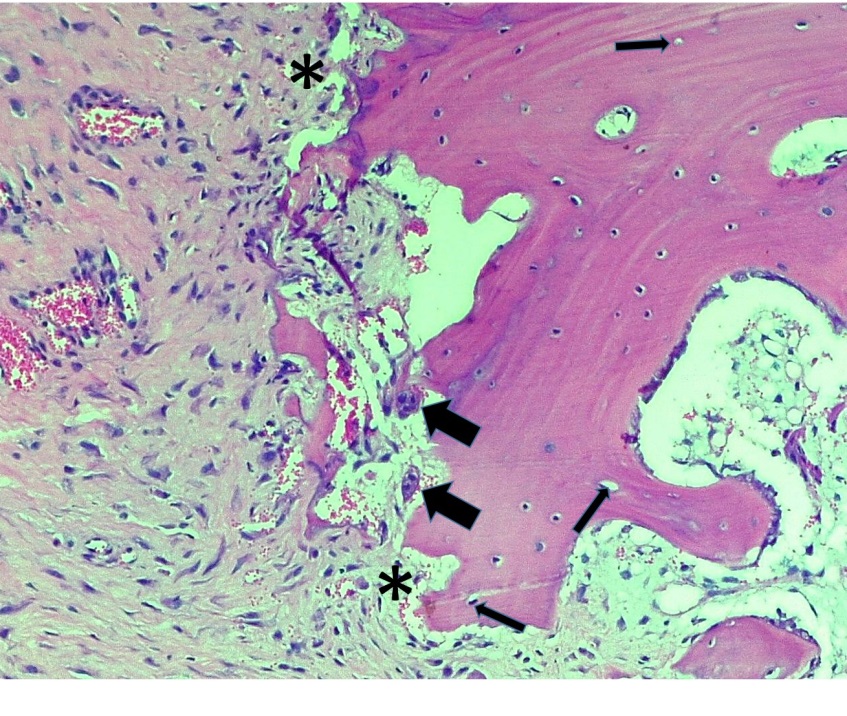 The bone marrow has been
replaced by fibrotic marrow in an eosinophilic matrix, this tissue as a whole
is partially connected to the necrotic bone (asterisks). Some multinucleated
giant cells can be seen in the periphery of the matrix (large arrows). There
are some empty gaps in the trabecular bone containing necrotic osteocytes (thin
arrows). (hematoxylin and eosin, 40x).